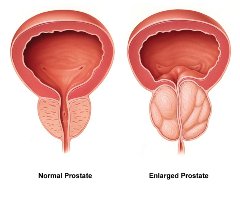 Prostate Health: The Silent Guardian of Your Well-Being